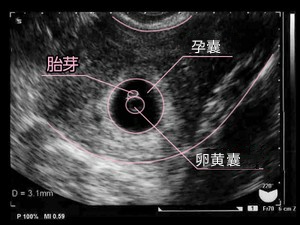 孕两个月孕囊大小，发育过程与影响因素解析